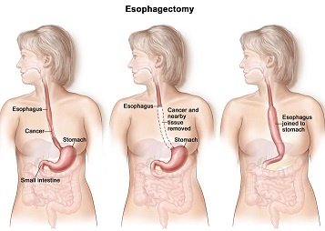 операции при раке пищевода