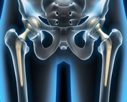 эндопротезирование коленного сустава в израиле