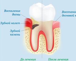 Как лечится гингивит