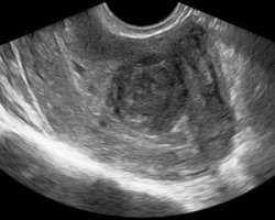 лечение миомы матки в израиле