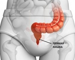 операции при онкологии прямой кишки