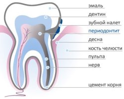 Лечение периодонтита