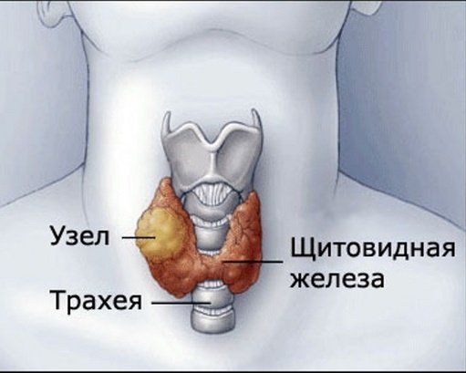 Побочные эффекты операции при раке щитовидной железы